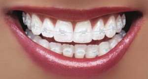 Ceramic-braces-online-300x161